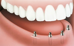 Implant-Supported Denture