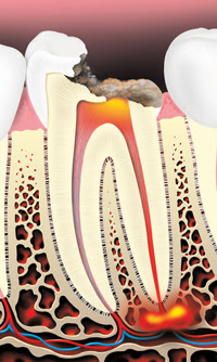 Root Canals 1