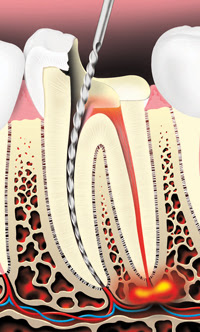 Root Canals 2